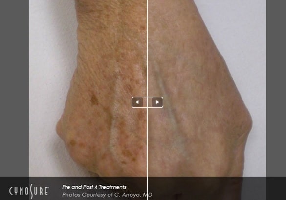 IPL-for-Website Before and After IPL Photofacial Sarasota FL