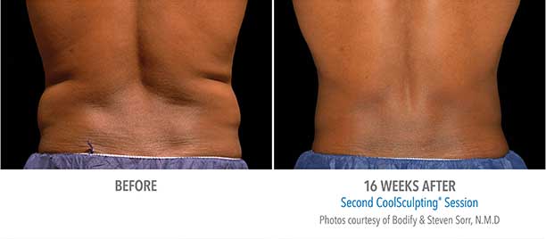 Lower Back Region CoolSculpting Before and After Sarasota FL Lower Back Region CoolSculpting Before and After Sarasota FL
