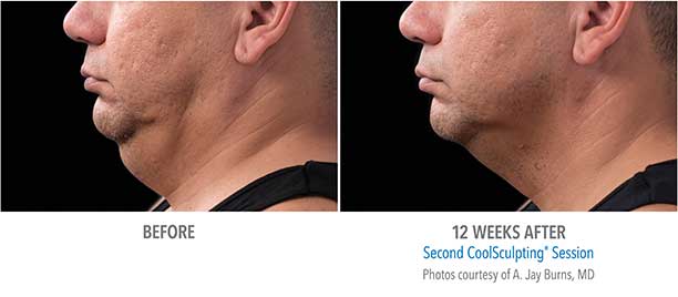 Chin Region CoolSculpting Before and After Sarasota FL Chin Region CoolSculpting Before and After Sarasota FL