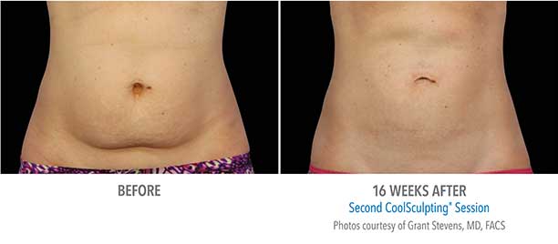 Abdominal Region CoolSculpting Before and After Sarasota FL Abdominal Region CoolSculpting Before and After Sarasota FL