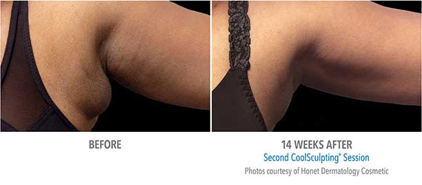 Upper Arms CoolSculpting Before and After Sarasota FL Upper Arms CoolSculpting Before and After Sarasota FL