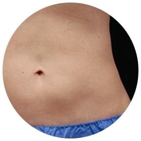 CoolSculpting Fat Reduction Sarasota FL CoolSculpting Fat Reduction Sarasota FL
