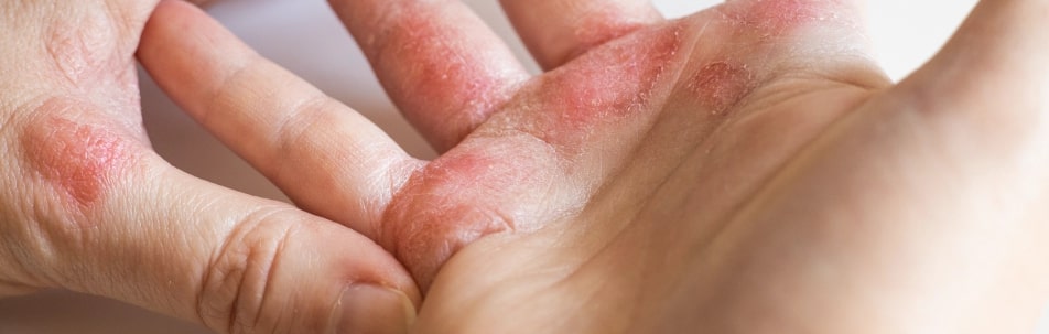 iStock 1303544329 Eczema Treatment Sarasota FL