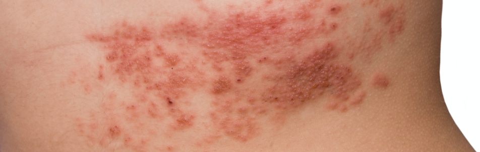 Skin Condition Treatment Sarasota FL