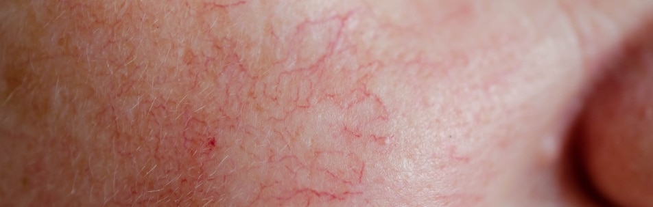 Rosacea Treatment Sarasota FL