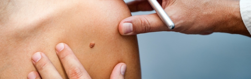 Mole Treatment Sarasota FL
