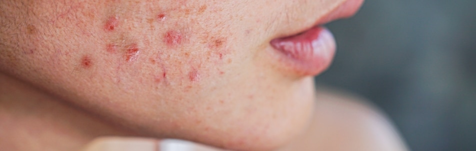 iStock 28 Acne Treatment Sarasota FL