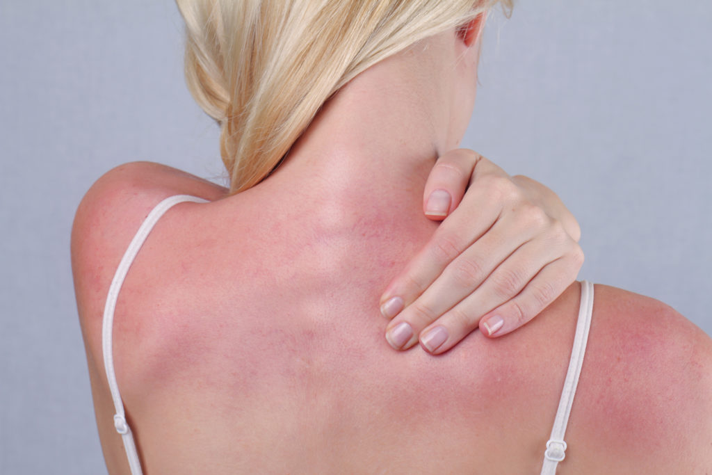 Sunburned woman