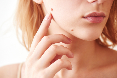 The mole on the girls face closeup
