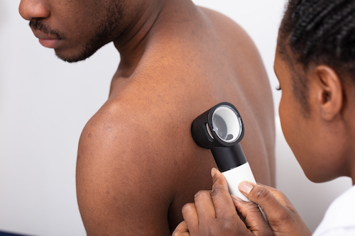 Skin cancer screening for melanoma
