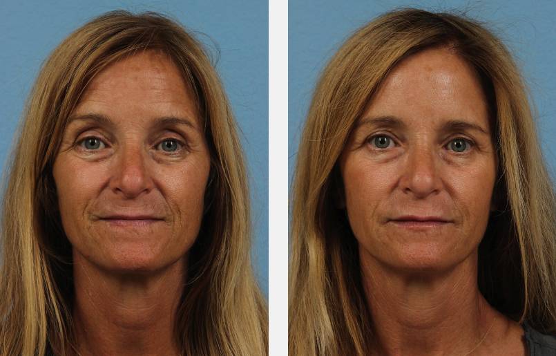 restylane