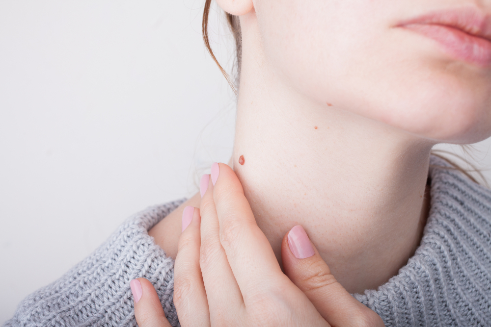 A close-up shot of a woman’s neck with a mole on it Fellowship-Trained Mohs Surgeon Florida