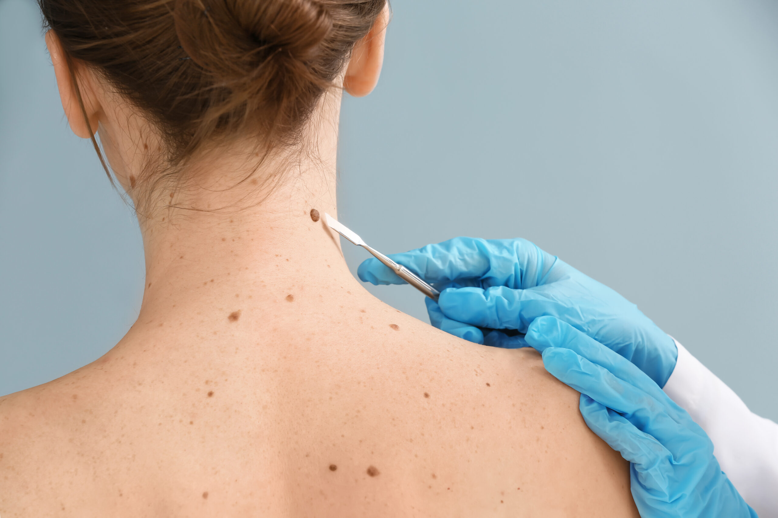 A surgical dermatologist examining moles on a patient’s neck