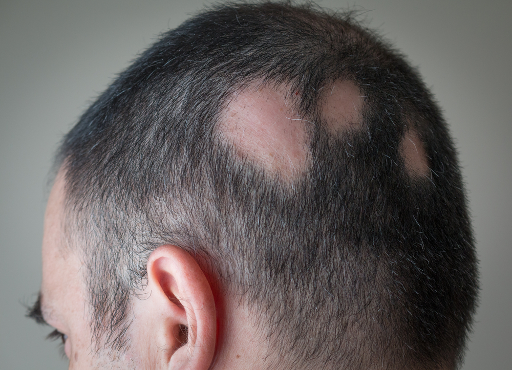Man with alopecia areata in Sarasota, FL