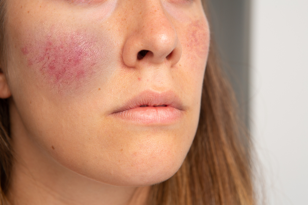 Woman with rosacea flareup on her cheeks. Woman with rosacea flareup on her cheeks.