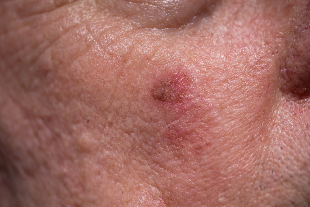 A close-up shot of an actinic keratosis lesion A close-up shot of an actinic keratosis lesion