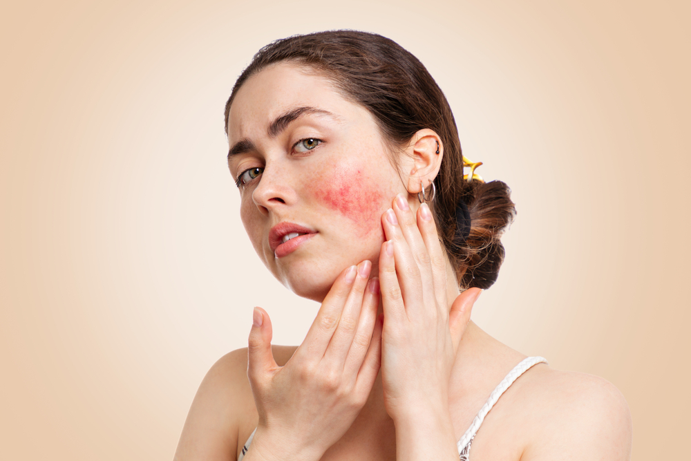 A woman with rosacea on her cheek