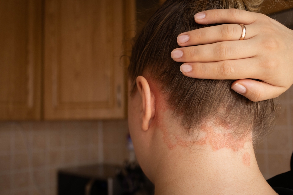 Woman in her kitchen reveals plaque psoriasis on the back of her scalp just underneath her hairline