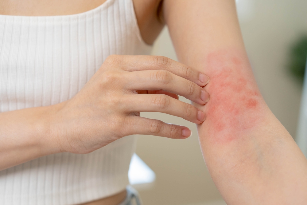 A close-up shot of eczema on a woman's arm A close-up shot of eczema on a woman's arm