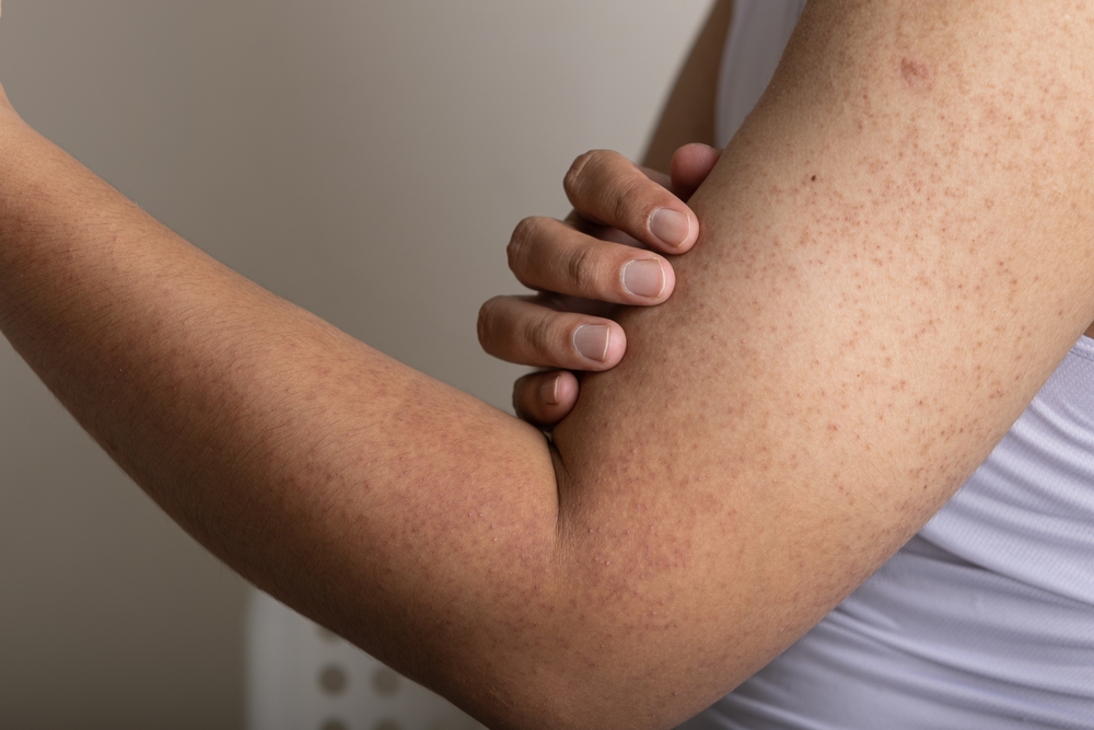 A close-up shot of keratosis pilaris on a woman's arm