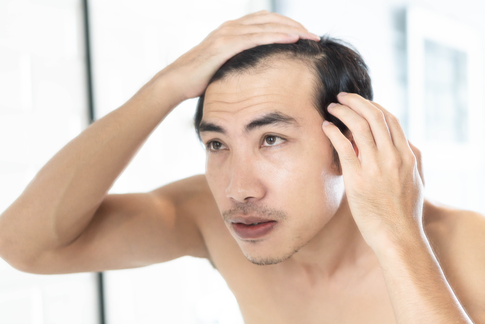 A man looking at his scalp after getting hair loss treatment in Sarasota A man looking at his scalp after getting hair loss treatment in Sarasota