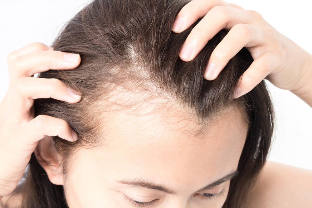 A close-up shot of a woman experiencing hair loss A close-up shot of a woman experiencing hair loss