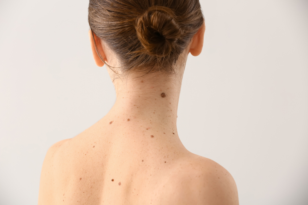 Moles on the back of a woman's neck Moles on the back of a woman's neck