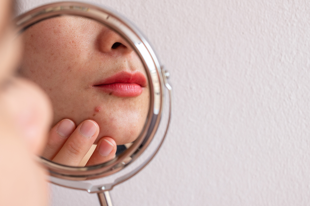 Woman looking worriedly into a small mirror after noticing acne, illustrating concerns about problem skin and the importance of acne prevention during the summer.