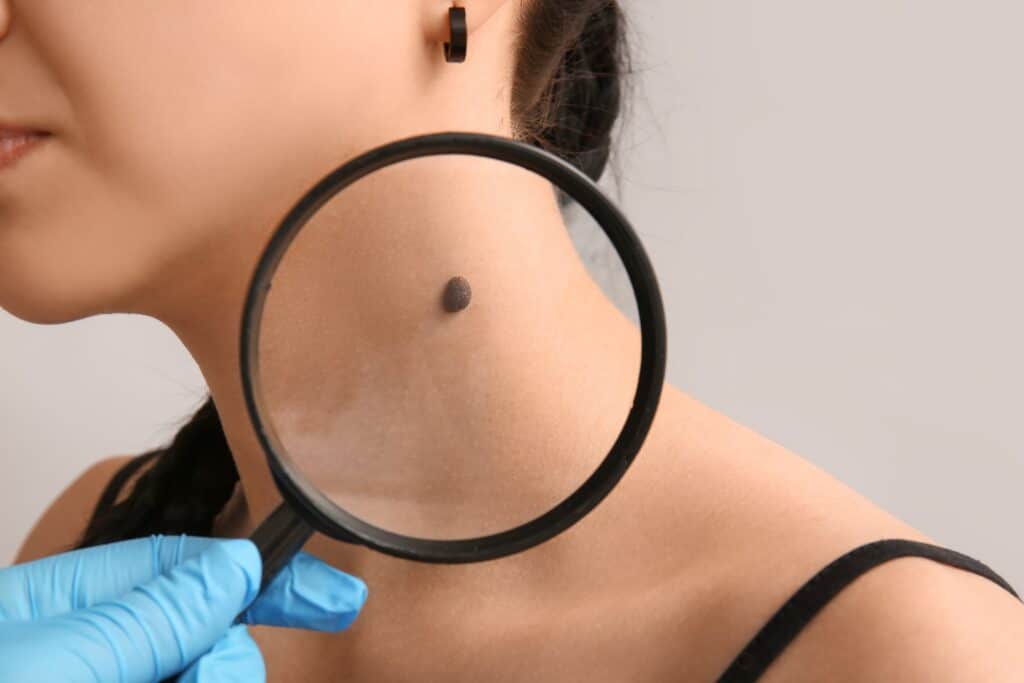 Close-up of dermatologist examining young woman’s mole with magnifier, concept of skin check, mole analysis, and dermatology care